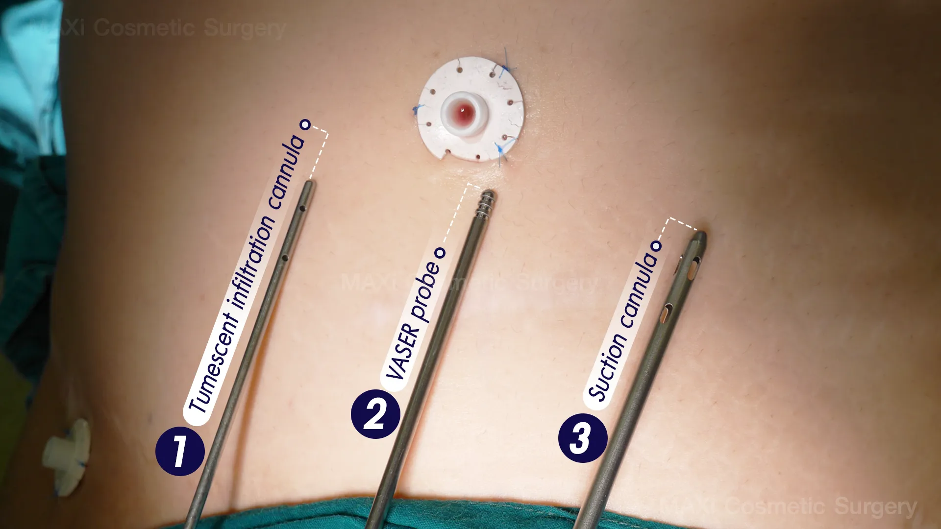 Advanced VASER liposuction procedure by Dr. Kanit showing precise fat removal process — VASER Liposuction in Thailand