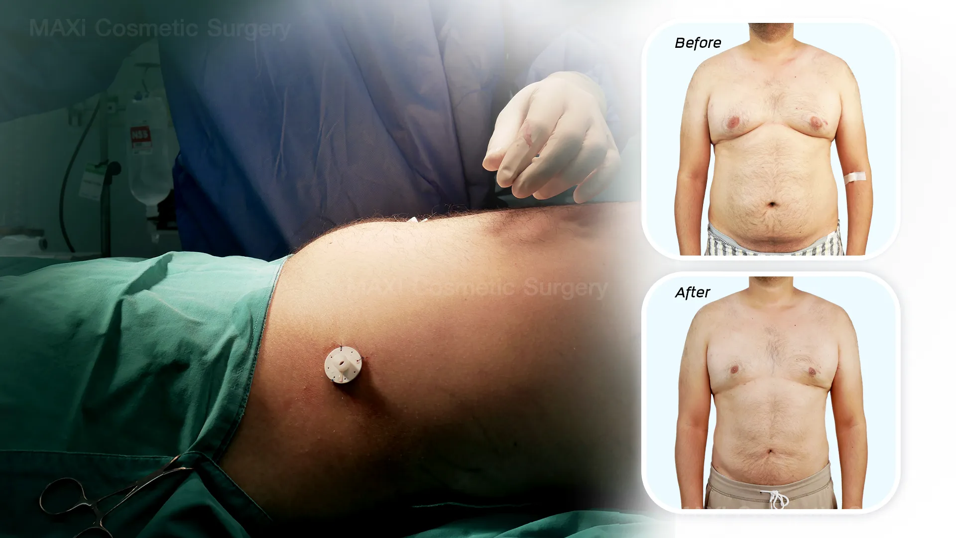 Before and after results of VASER Smooth 2.2 liposuction showing significant fat reduction and smoother body contour — VASER Liposuction in Thailand with Dr. Kanit