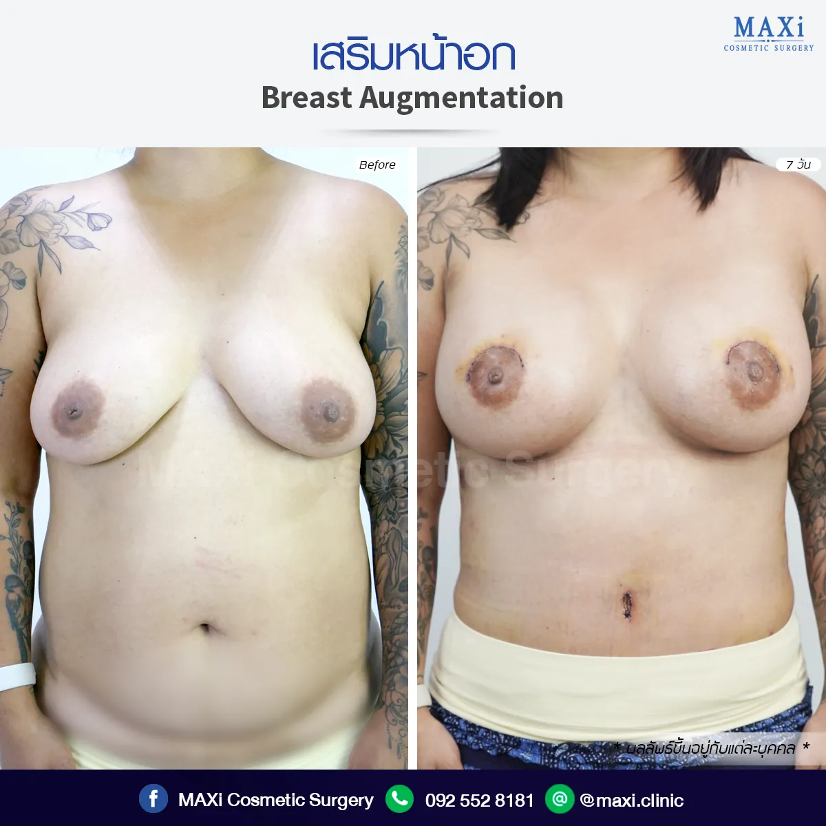 Before and after breast implant transformation with natural proportions
