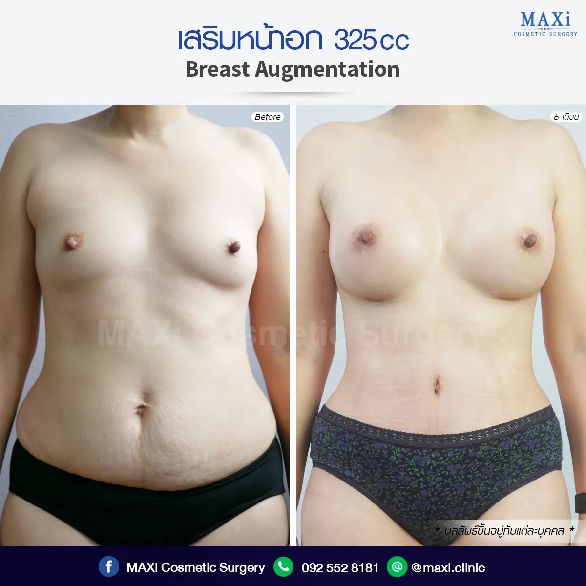 Breast augmentation before and after with teardrop-shaped implants