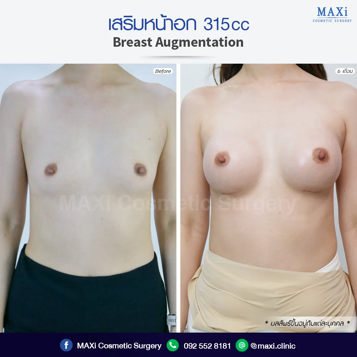 Before and after breast augmentation surgery for improved confidence and shape