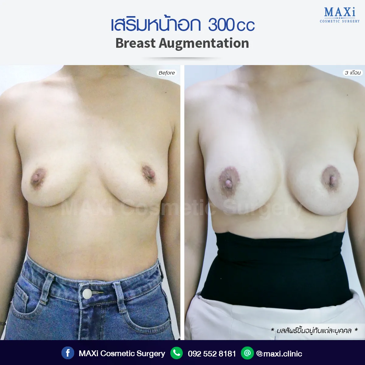 Real patient results before and after breast augmentation with silicone implants