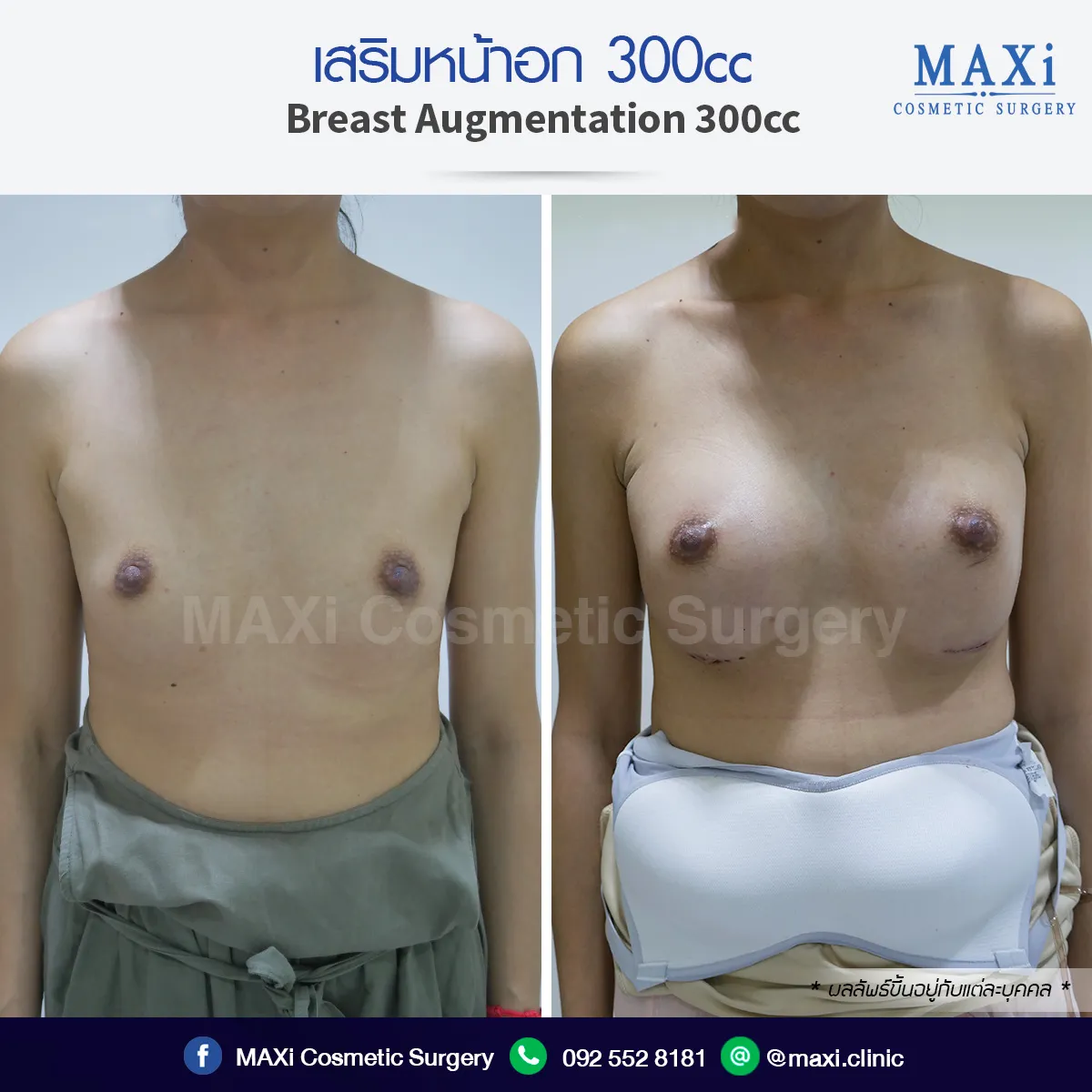 Before and after breast augmentation showing natural and balanced results