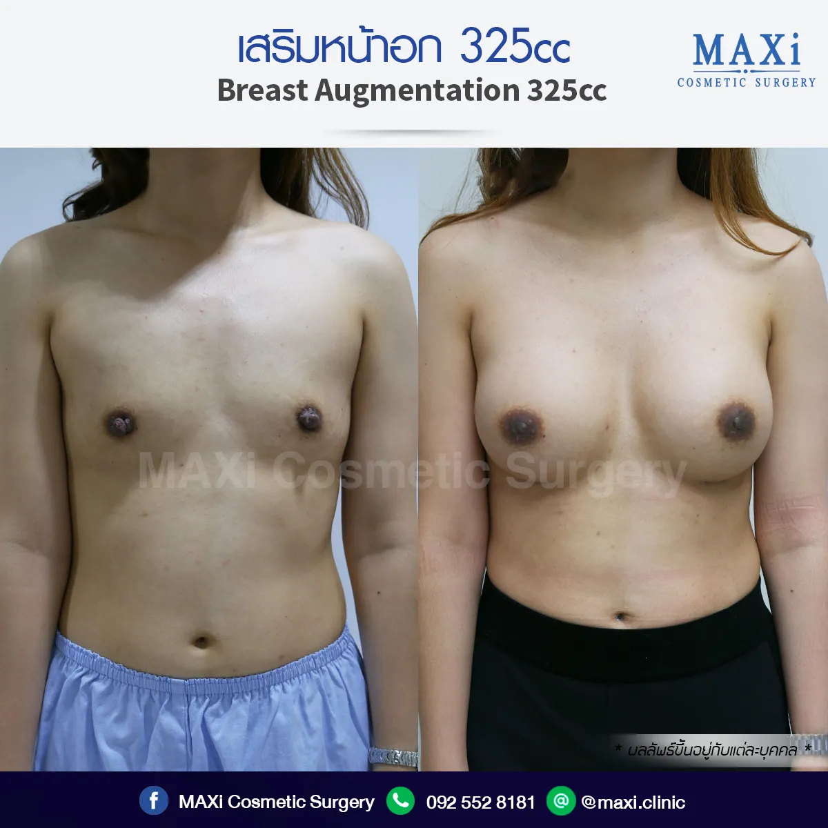 Breast implant before and after photo with soft, natural-looking outcome