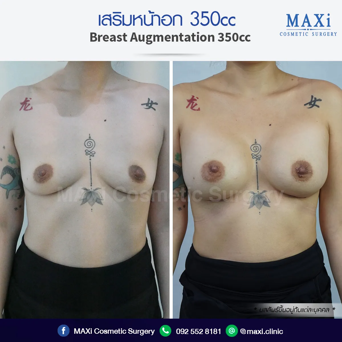 Before and after breast enhancement surgery for fuller, beautiful breasts