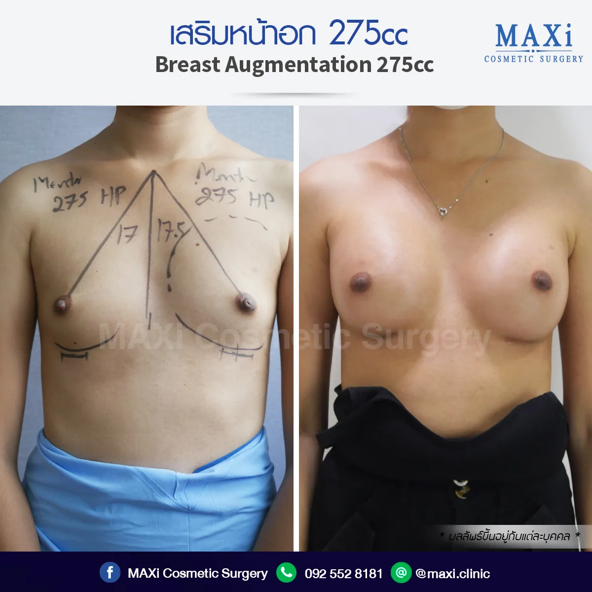 Natural breast augmentation results before and after cosmetic surgery