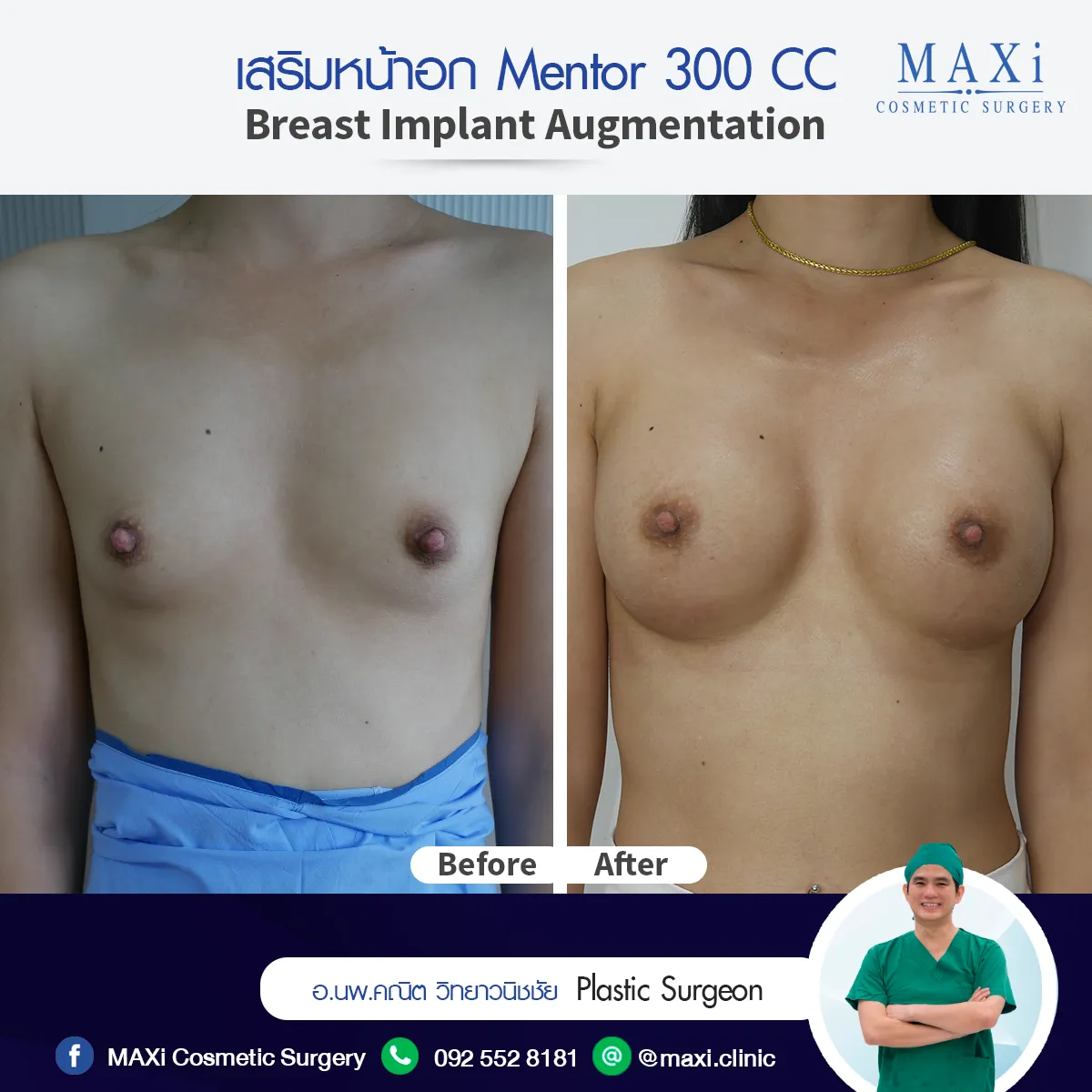 Before and after photos of breast enlargement for natural, soft contour