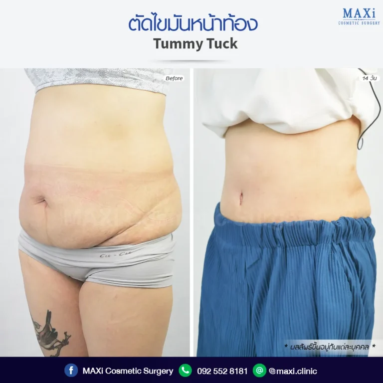 Before and after Tummy Tuck surgery showing improved abdominal contour and firmer, flatter abdomen