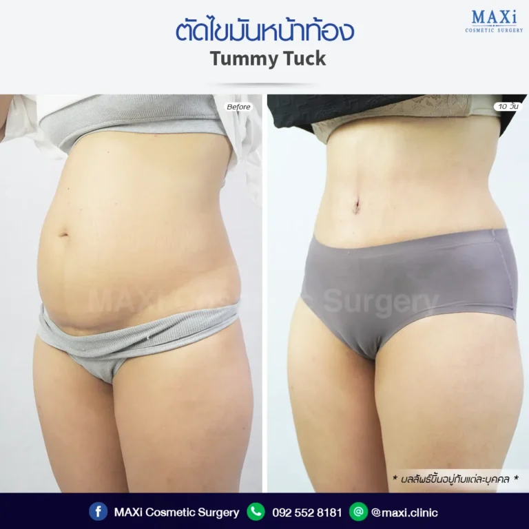 Tummy Tuck before after results demonstrating removal of excess skin and tightened abdominal muscles