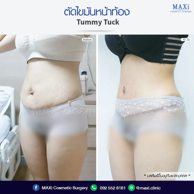 Tummy Tuck surgery before and after images revealing restored abdominal firmness and body confidence