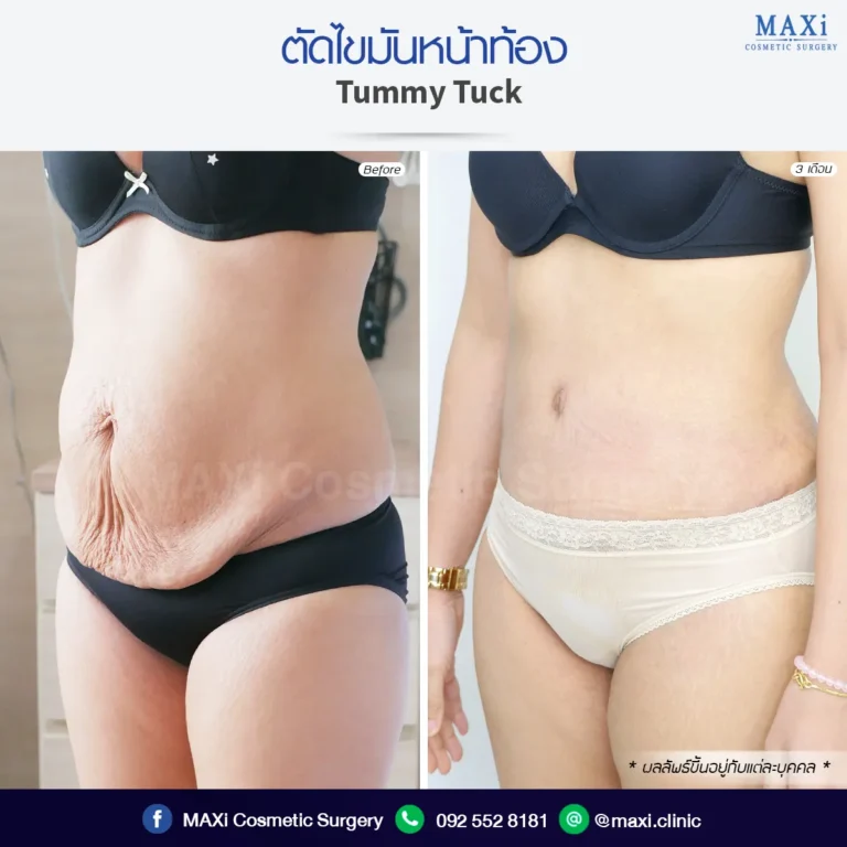 Before after Tummy Tuck procedure highlighting dramatic waistline improvement and smooth abdominal shape