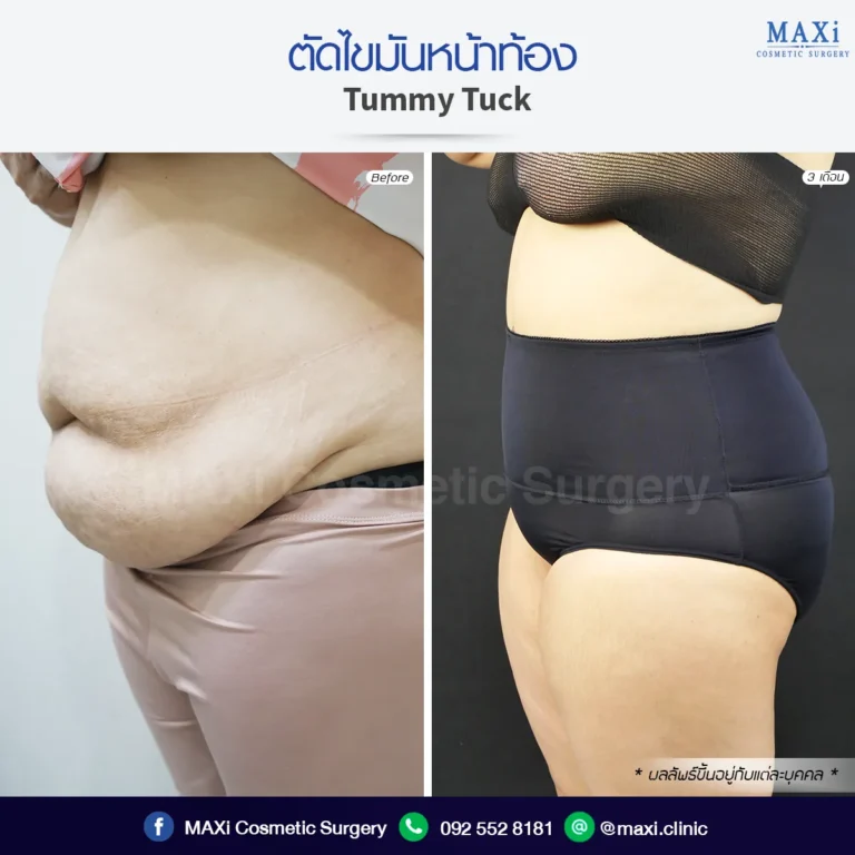 Tummy Tuck before after comparison showing enhanced body contour and flat stomach appearance