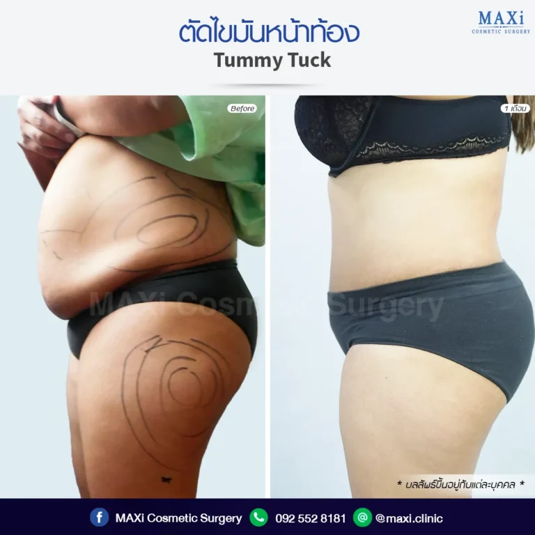 Before and after Tummy Tuck transformation with visible tightening of loose abdominal skin